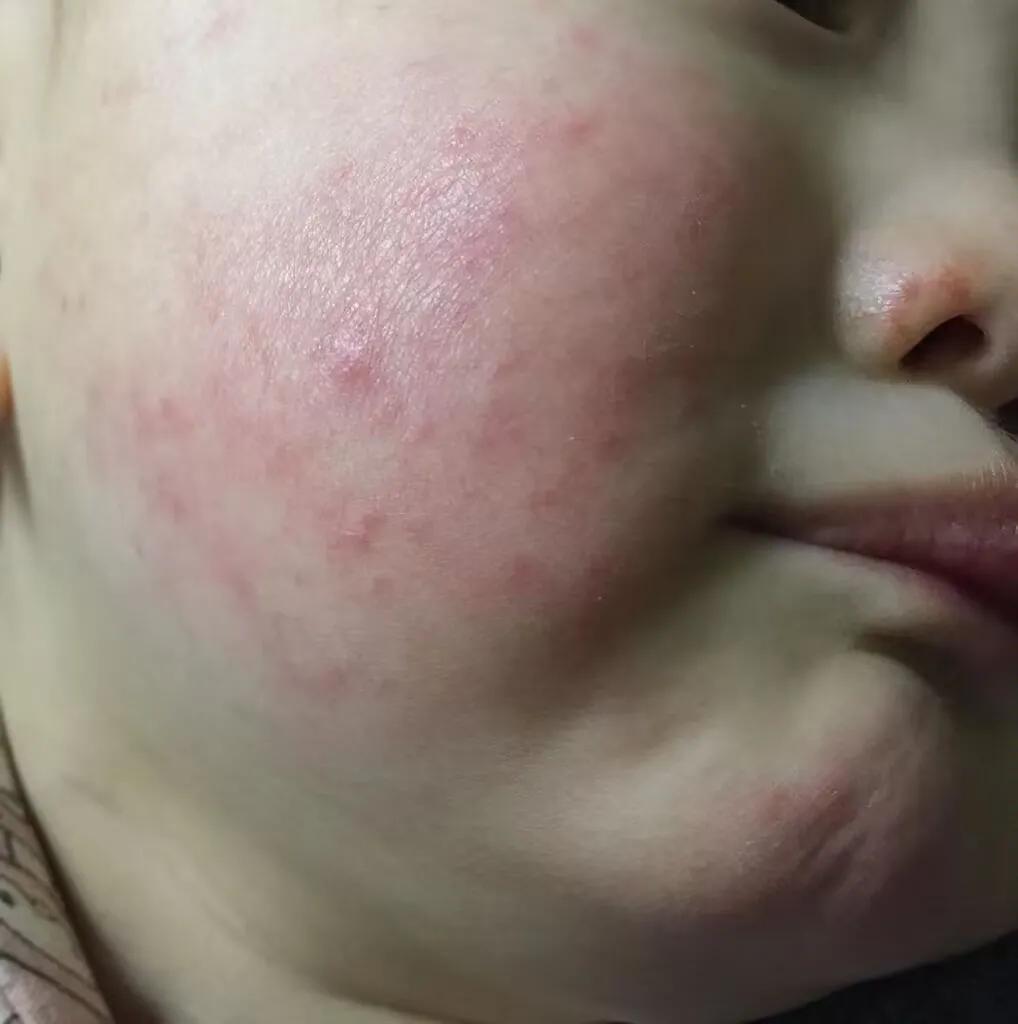 小孩身上抓破皮擦什么好,宝宝皮肤抓破皮有些感染怎么处理