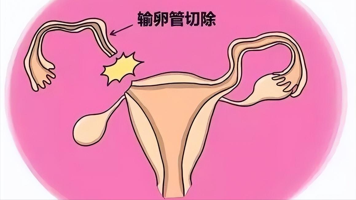 宫外孕都是有什么状况,宫外孕是什么原因造成的严重吗