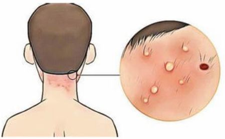 毛囊炎怎么彻底根治最有效的方法,毛囊炎的后果是什么