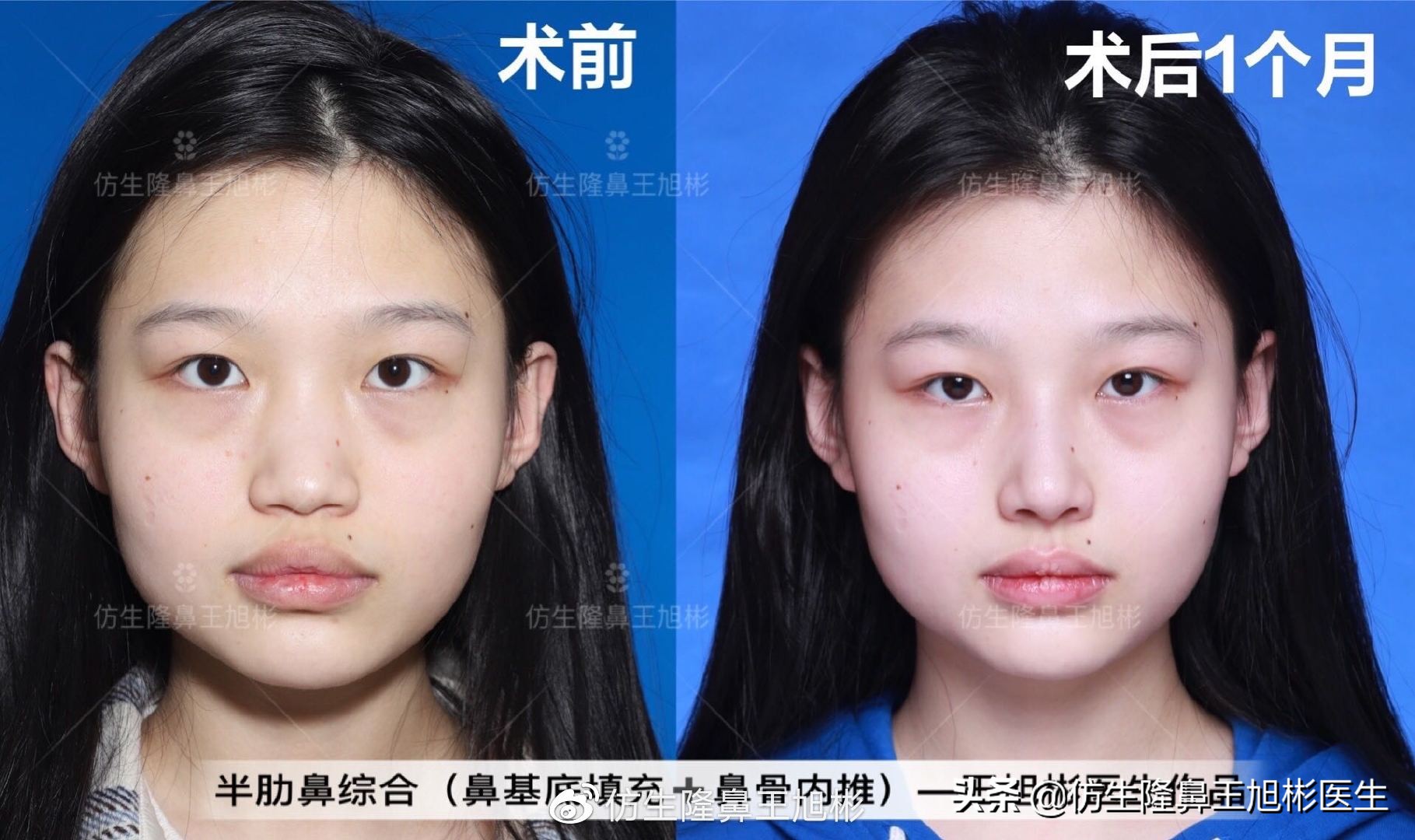 常见鼻部整形美容项目,整形鼻和自然鼻