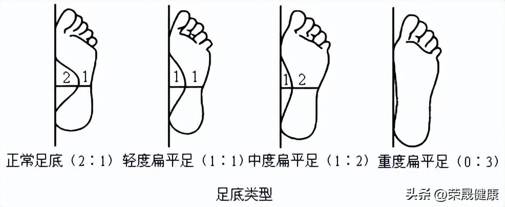 不想成为“唐老鸭”，这些在家就能做的平足练习一定要学起来！