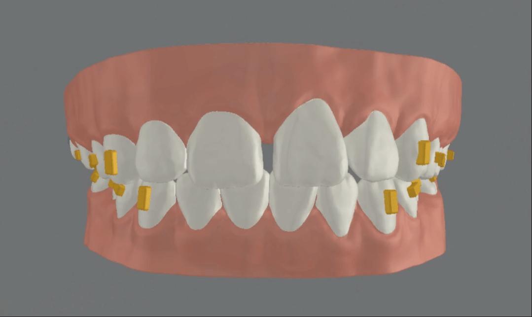 无托槽隐形矫治流程,隐形矫正早期干预