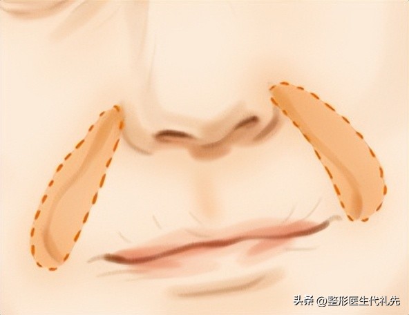 面部法令纹怎么去除,去除法令纹的日常方法