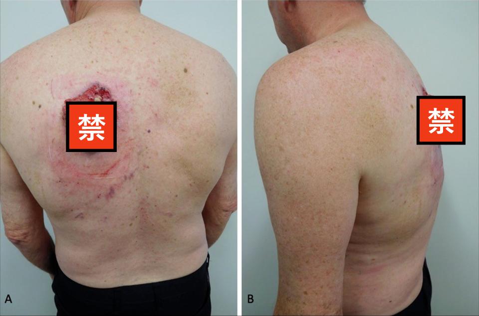 基底皮肤癌治疗手段及治愈率,基底细胞癌的中药偏方