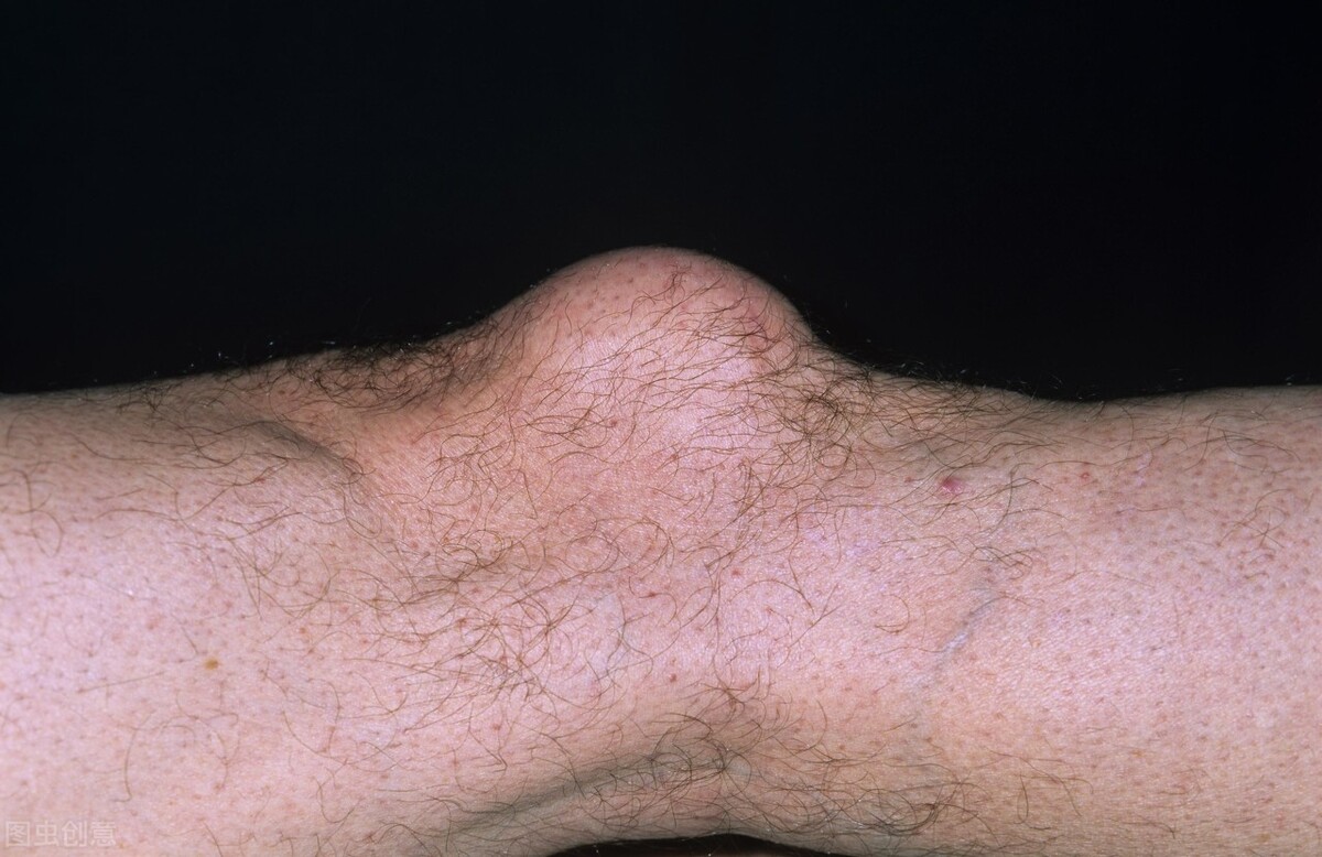 土方法治风湿性关节炎,风湿性关节炎该怎么治疗