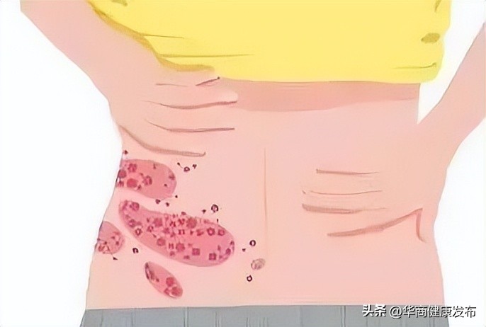 带状疱疹会传染给孕妇吗,带状疱疹会传染孕妇吗