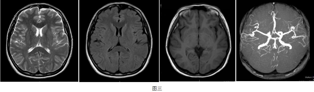 一打喷嚏就头疼是什么类型的感冒,一打喷嚏就感冒是什么原因