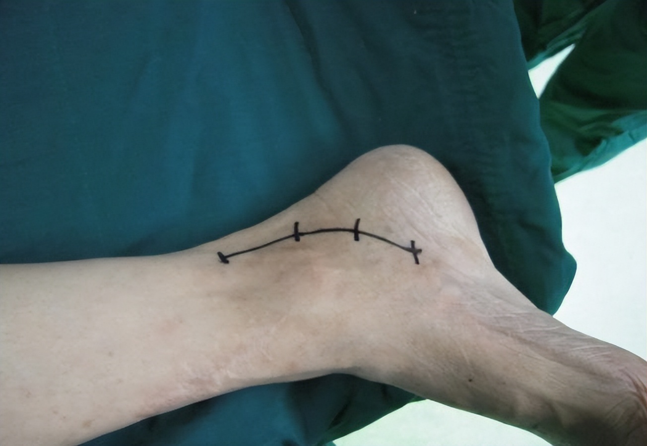 下肢寒凉麻木,糖尿病引起的下肢麻木如何治疗