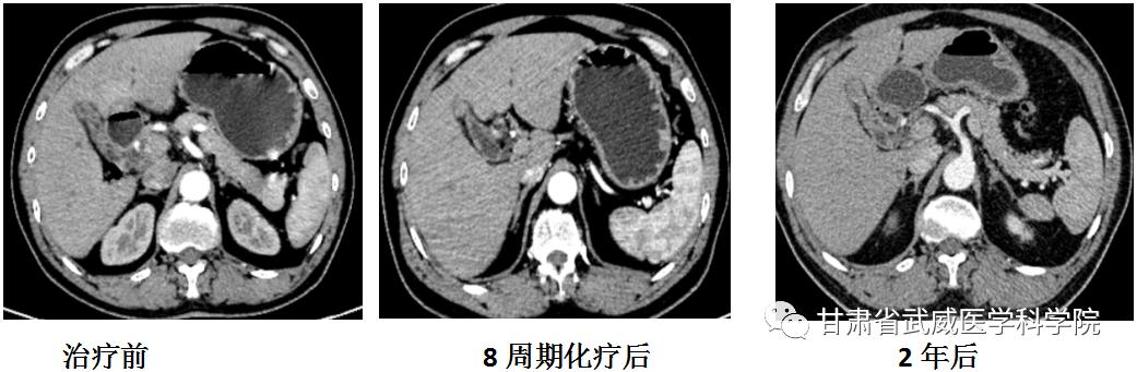 胆囊癌晚期中医治疗真实案例,晚期胆囊癌治好的案例