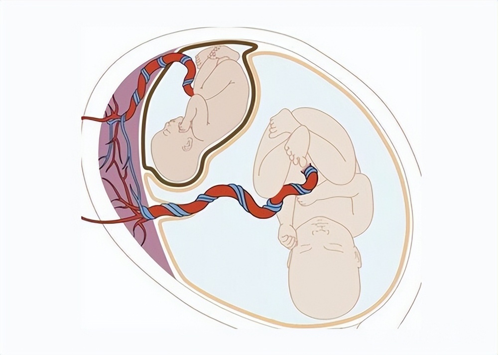 女童肚子超大疑似怀孕,2岁女婴肚中发现“胎儿”