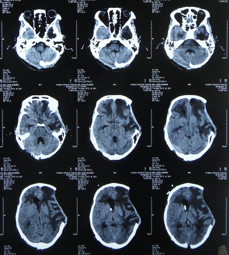 脑外伤开颅手术后继发癫痫,开颅术后颅内感染