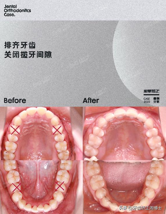 闭嘴巴下巴有核桃纹做什么手术,为什么下巴会有像核桃一样的纹路