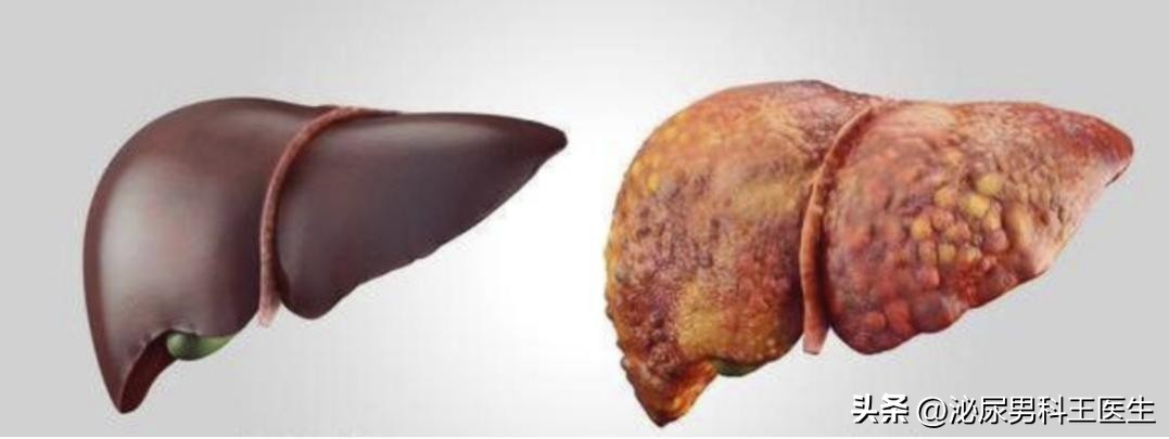 肝硬化失代偿期浑身瘙痒吃什么药,皮肤瘙痒检查竟是肝脏问题