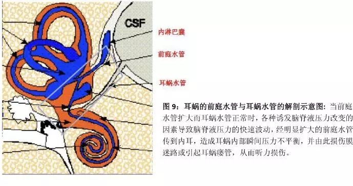 大前庭导水管正常值,大前庭导水管结构