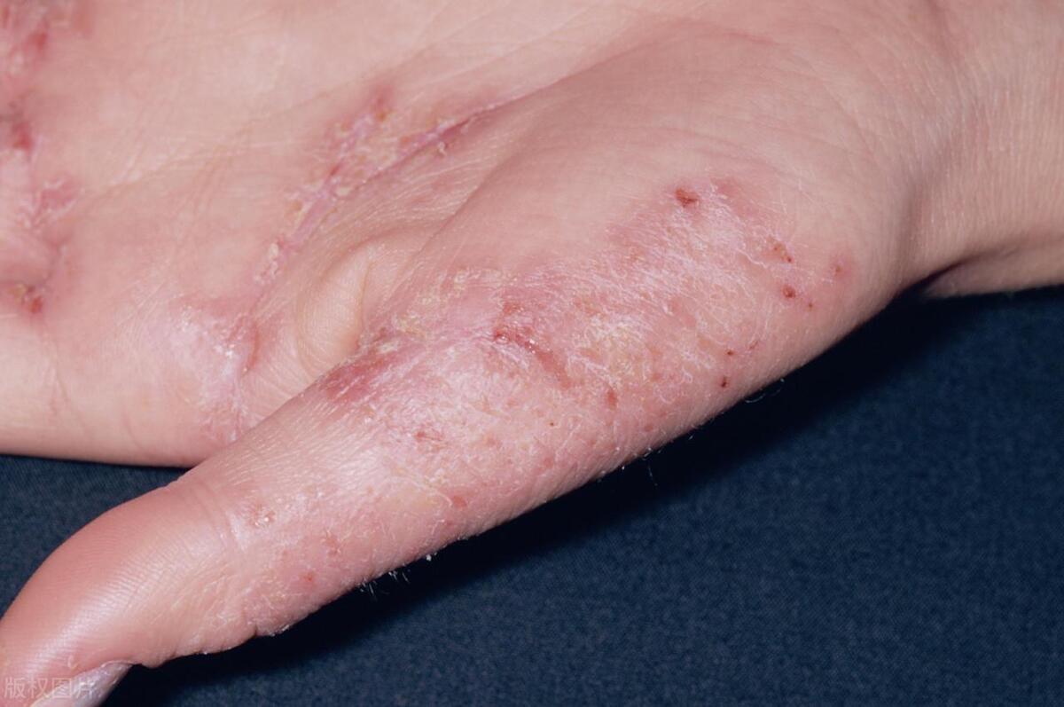 万能止痒特效药外用药,全身湿疹止痒神器