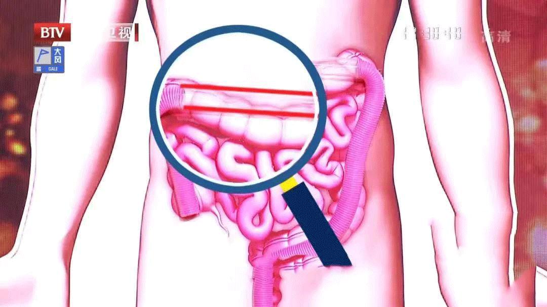 坏胆固醇对血管有什么危害,坏胆固醇对血管的危害