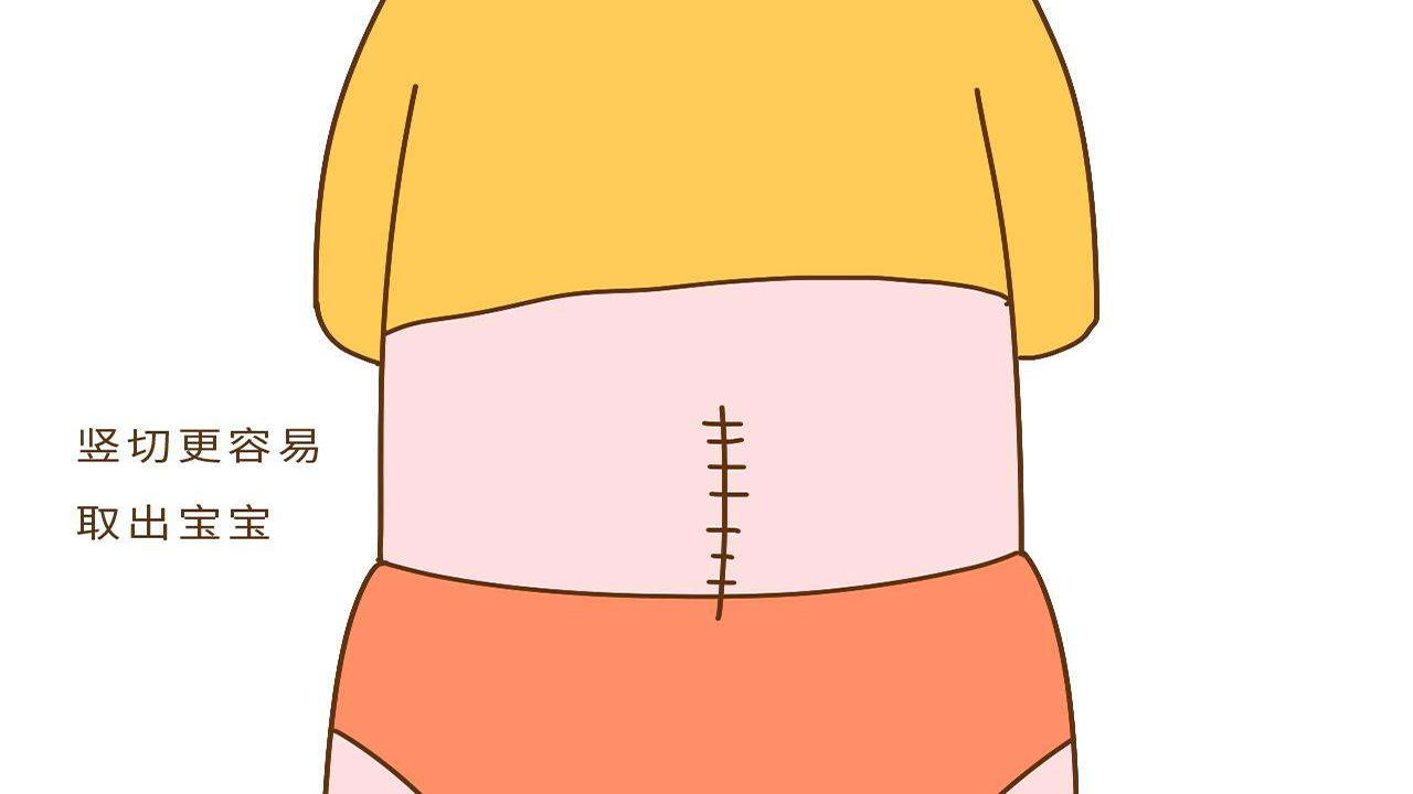 顺产VS剖宫产到底哪个好？终于有医生讲明白了，看完请多爱护女性