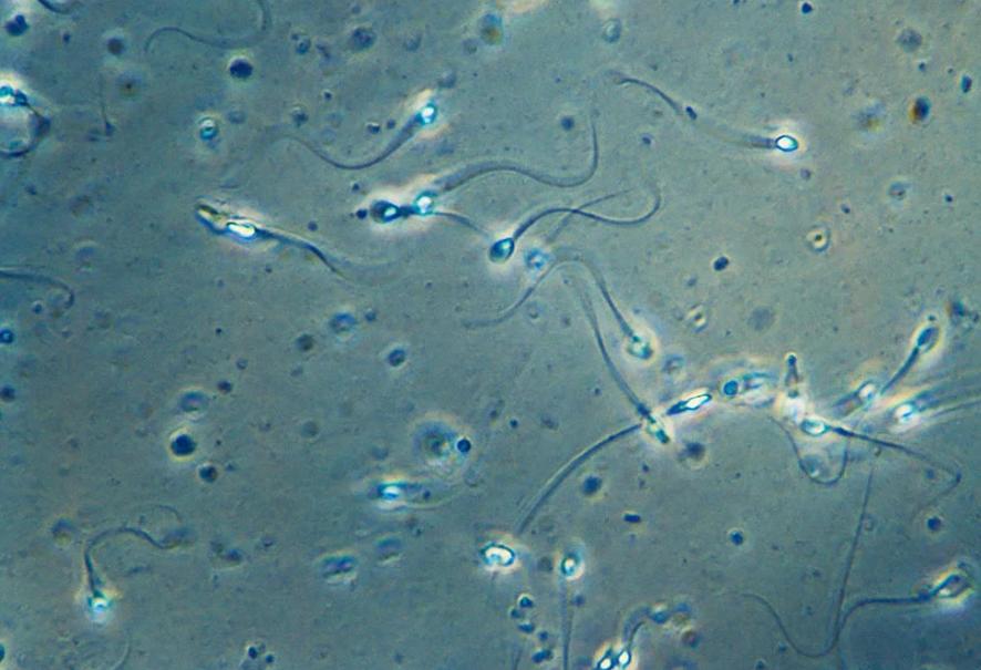 死精症是怎么回事,男人有死精症可以治好吗