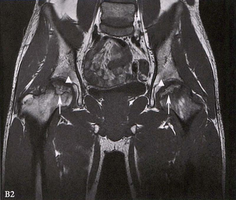全国十大股骨头坏死诊疗中心,股骨头坏死诊疗方法有哪些