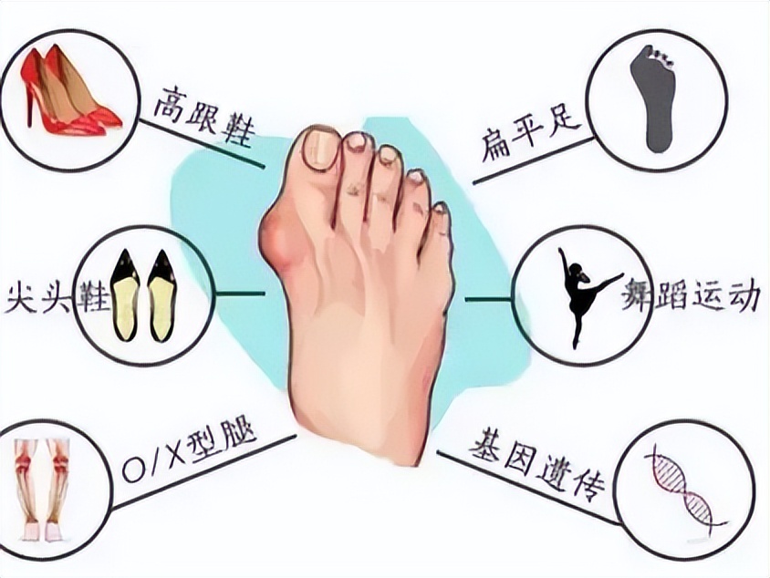 如何让脚趾变美观,小脚趾缺失两节对美观影响吗