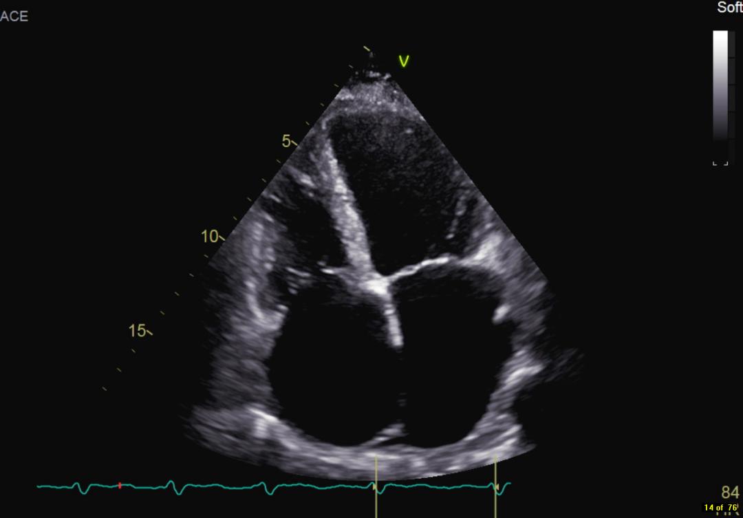 10岁女孩心脏有杂音是怎么回事,她的心脏