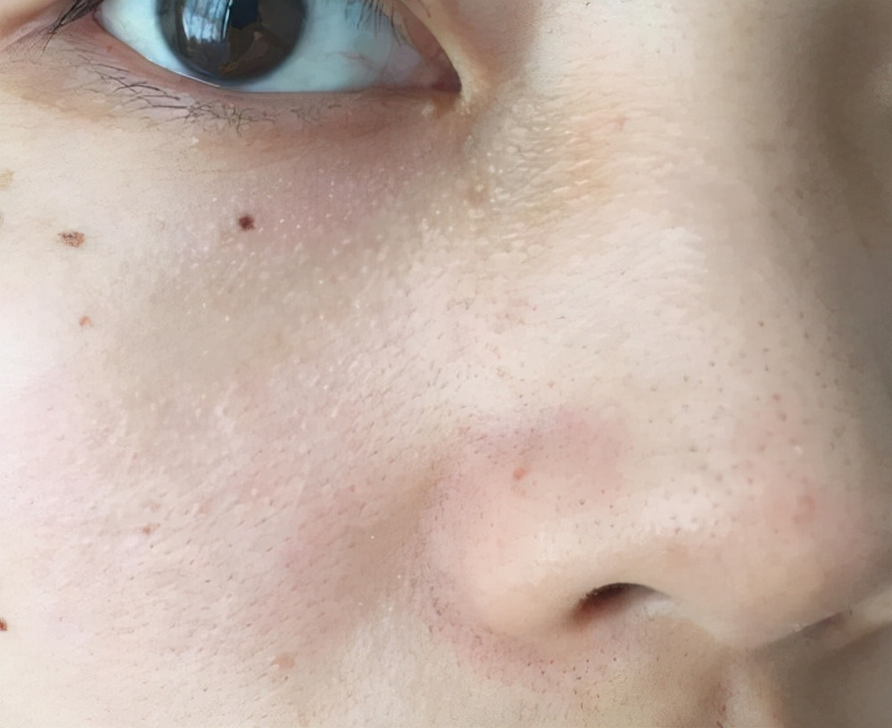 鼻子上挤出来的白色条是什么,鼻子里有白色条状粘稠物