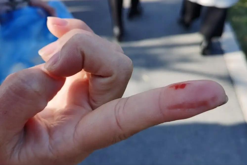 红霉素软膏护肤妙用,红霉素软膏的十大作用