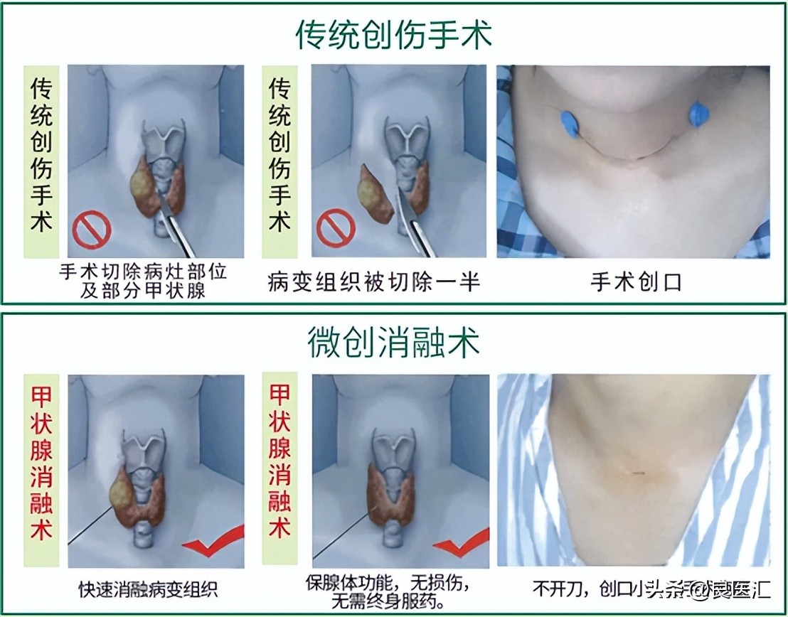 栓塞介入能消灭肿瘤吗,手术不用刀