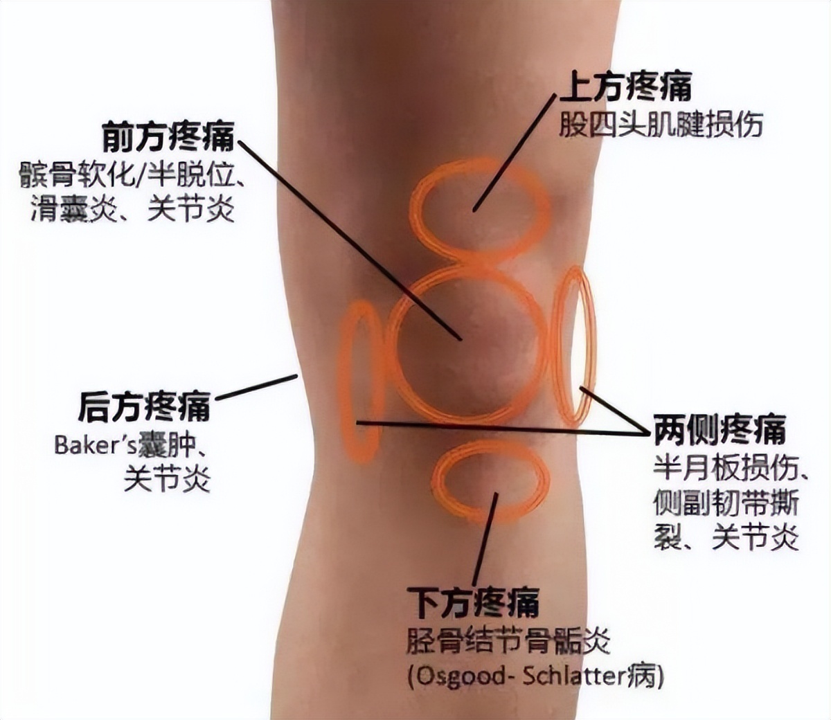 膝关节疼痛是怎么回事怎样治疗,膝关节发软无力疼痛如何缓解