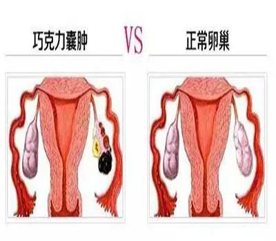 巧克力囊肿科普视频,卵巢巧克力囊肿最新治疗方法