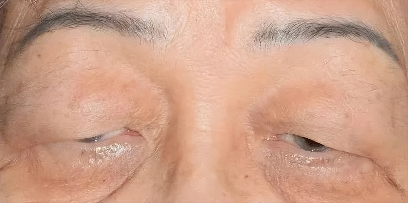 眼皮肿要警惕四种病,眼皮沉重乏力什么原因