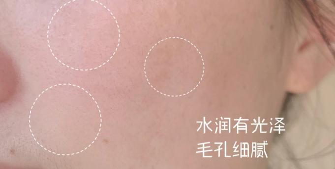 痘痘肌敏感肌良心推荐,痘痘肌敏感肌精华水推荐