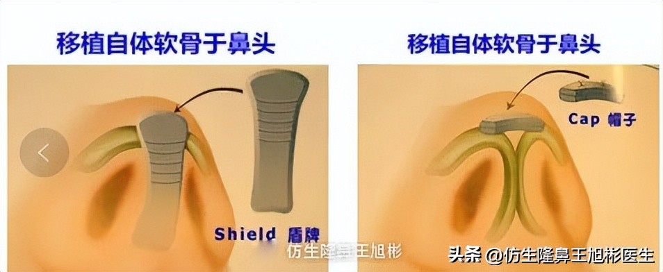 耳软骨隆鼻鼻小柱也是用耳软骨吗,耳软骨隆鼻可以摸到鼻尖的软骨吗