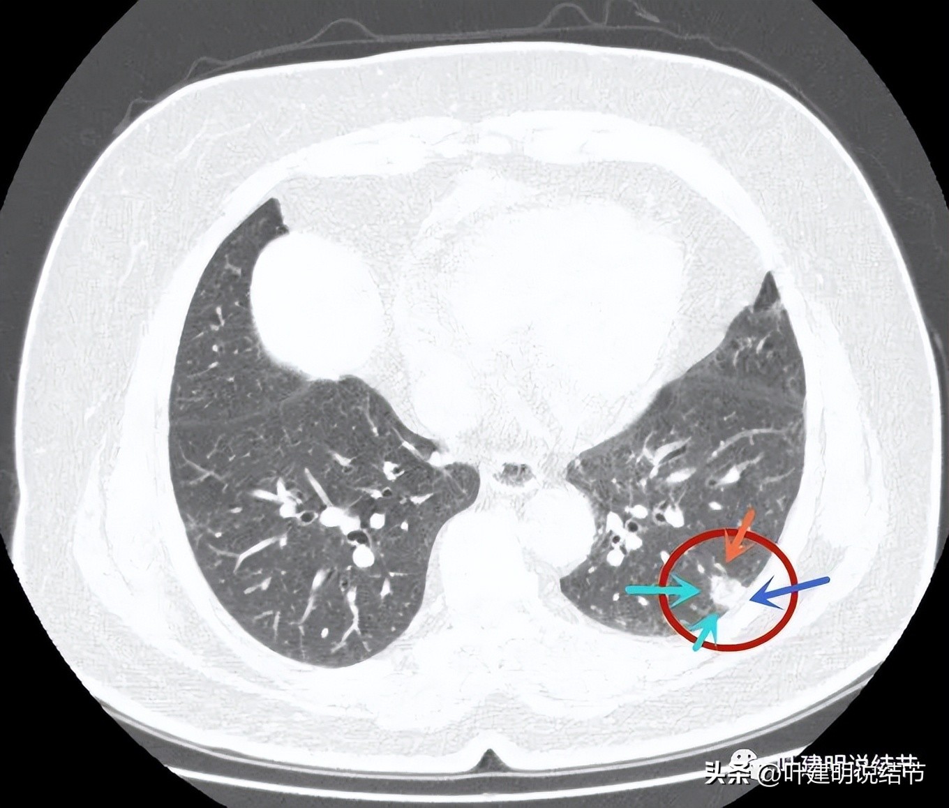 肺结节实性为什么建议抗炎治疗,肺上实性结节抗炎后变成空洞