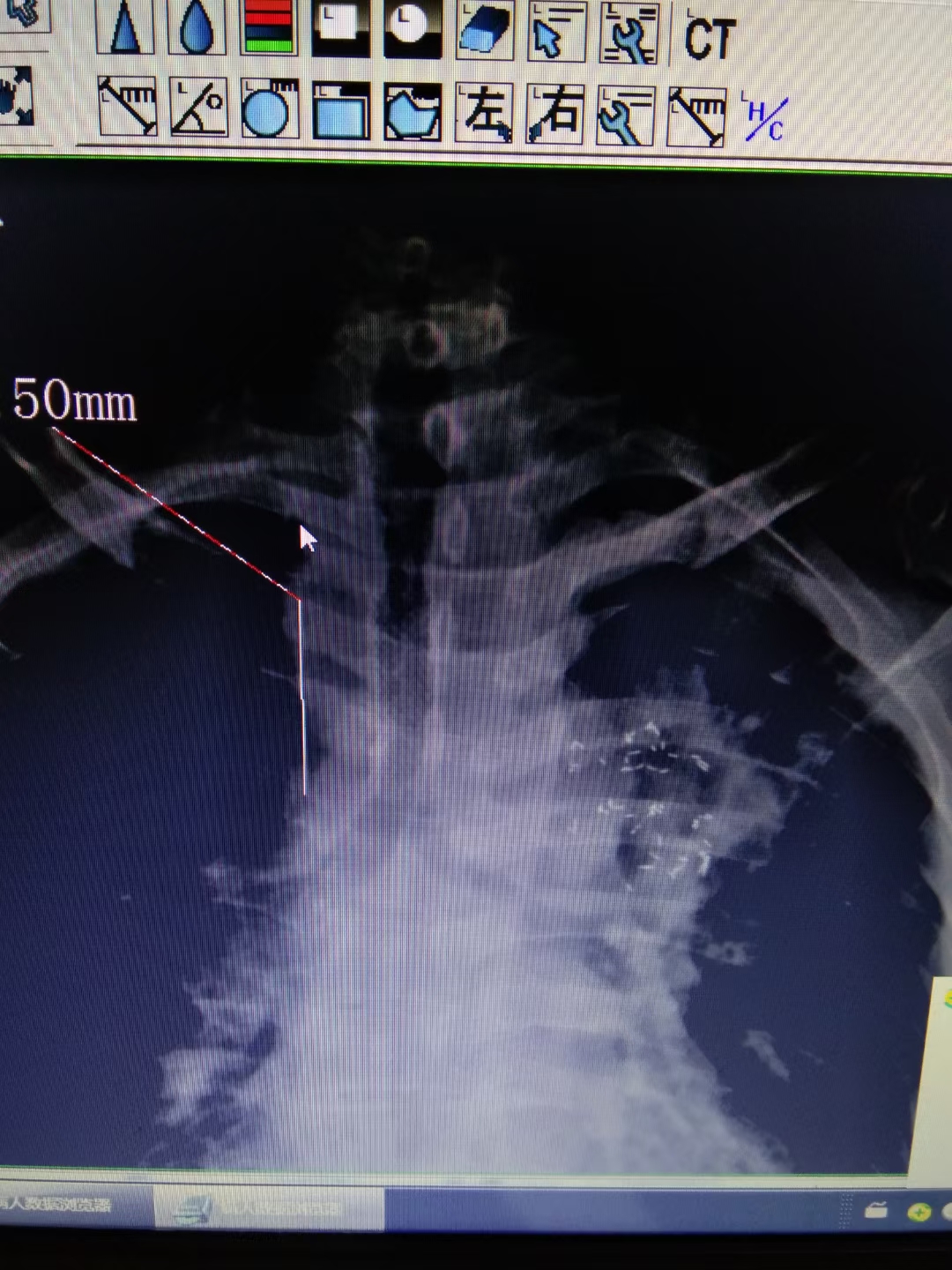 肿瘤压迫气管呼吸困难护理措施,肿瘤压迫气管呼吸困难怎么办