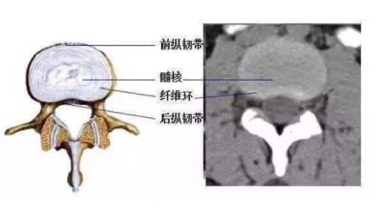 腰椎间盘突出可以练瑜伽吗,腰椎间盘突出可以骑自行车吗