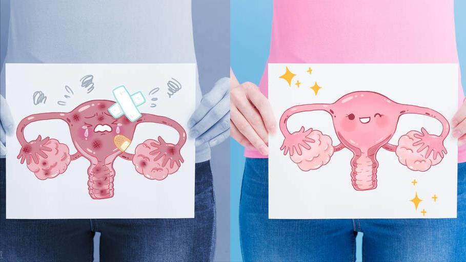 卵巢巧克力囊肿合并多囊卵巢,什么是巧克力卵巢囊肿怎么治疗