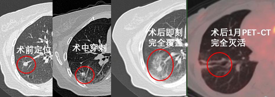 肺癌结节热消融术,肺肿瘤冷冻消融术能根治肺癌吗