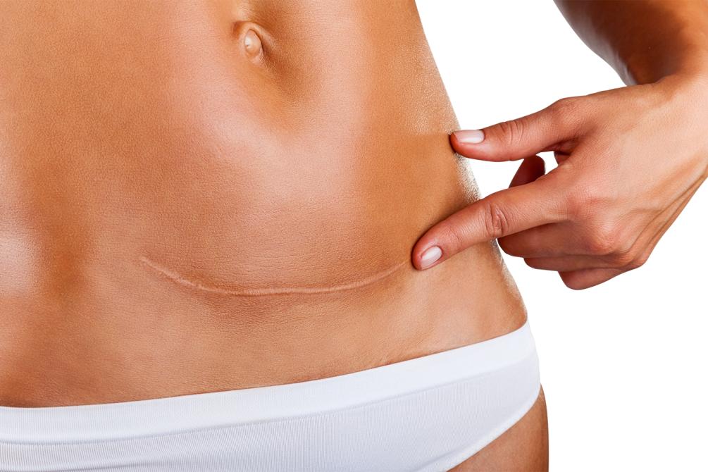 剖腹产切断了哪几条经络,剖腹产经脉切断还能恢复吗