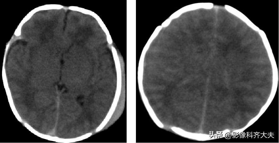 新生儿缺氧缺血性脑病的mr诊断,新生儿缺血缺氧脑病的ct表现