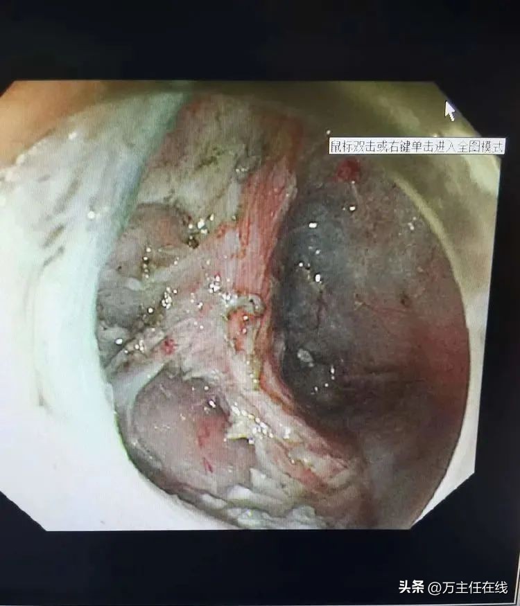 上海第一人民医院消化科万荣教授,消化内科专家手术