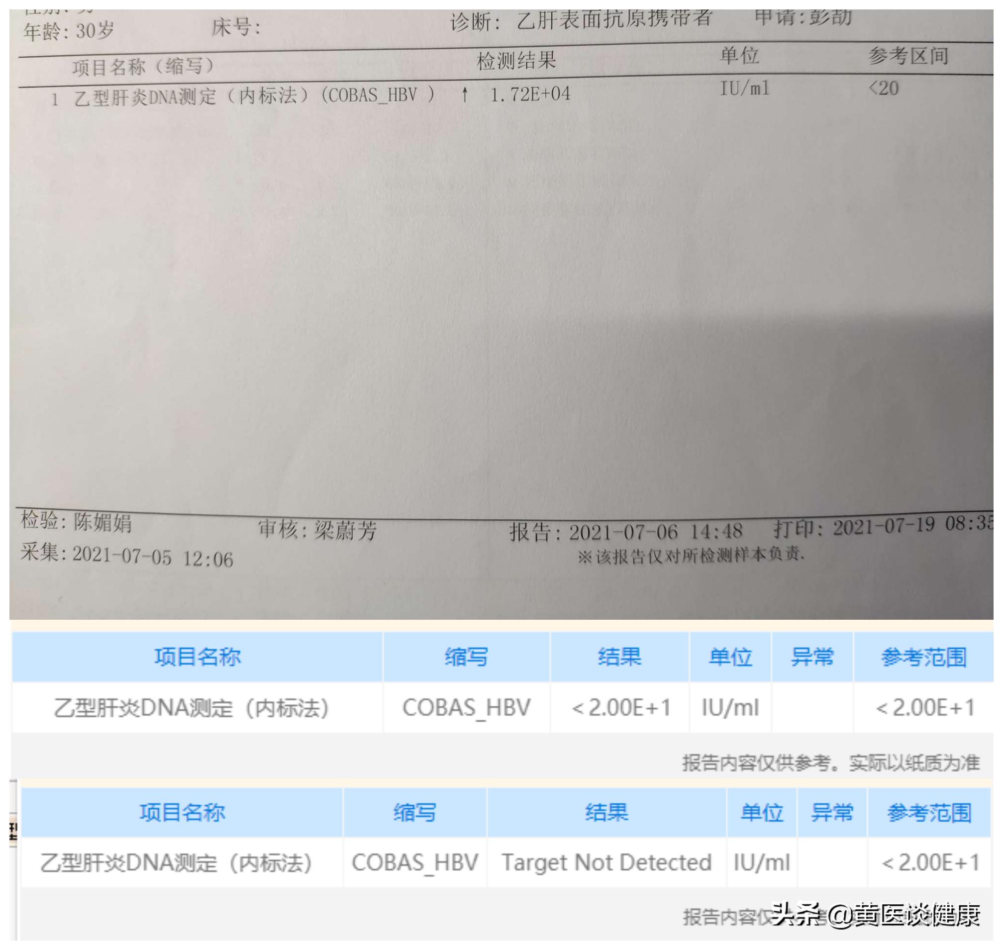 抗病毒三个月肝硬度反而升高,肝抗病毒后抗体升高