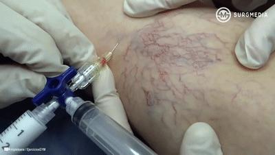 神奇！打针就能治好静脉曲张，这个白泡泡秒杀“小蚯蚓”