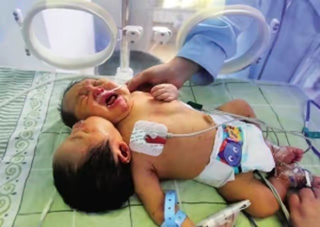 中国首例双头婴儿现状如何,全国首例双头婴儿现在咋样了