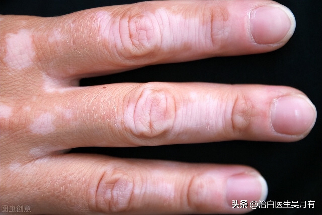 用308准分子激光治疗白癜风的话，治好后还会复发吗？