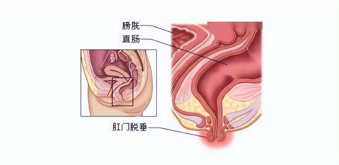 肛门有小肉疙瘩怎么治疗,肛门长小肉疙瘩怎么治疗