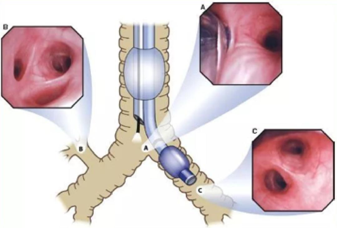 咯血一定要做支气管镜吗,支气管镜的注意事项