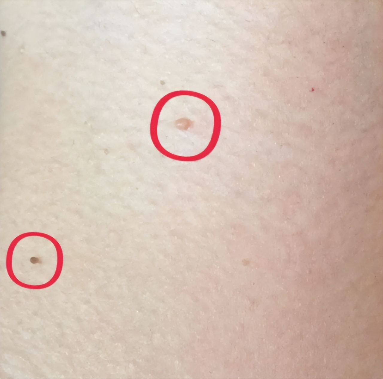 脖子上透明小肉粒可以揪下来,脖子上的小肉粒可以揪下来吗