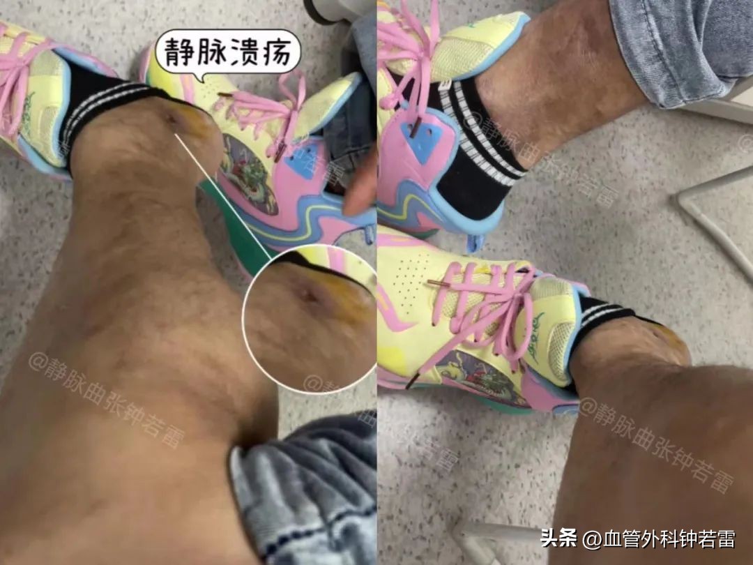 浙江39岁崔先生脚上“破了个洞”千里寻医验证联合微创科学方法！