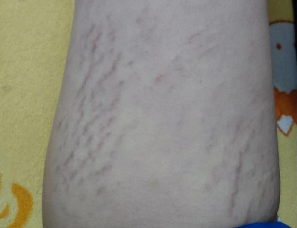 红色肥胖纹和白色肥胖纹淡化,肥胖纹能彻底消除吗